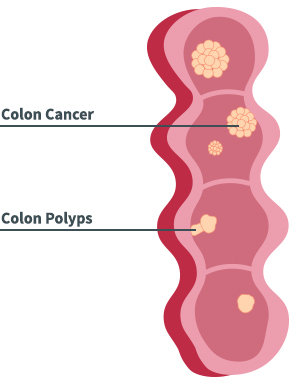 Colon Disease Diagram