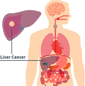 Liver Cancer Diagram