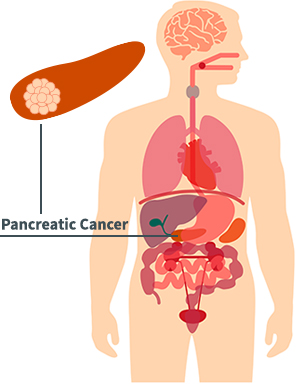 Pancreatic Cancer Diagram
