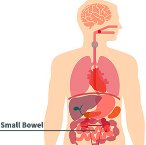 Small Bowel Cancer Diagram