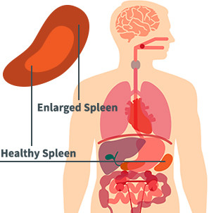 Spleen Disease