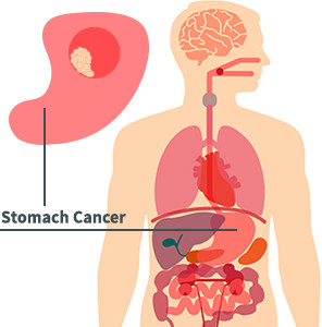 Stomach Cancer Diagram