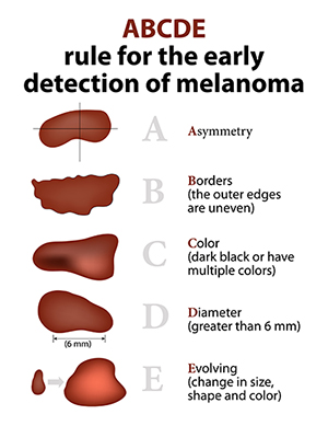ABCDE Rule for the early detection of melanoma