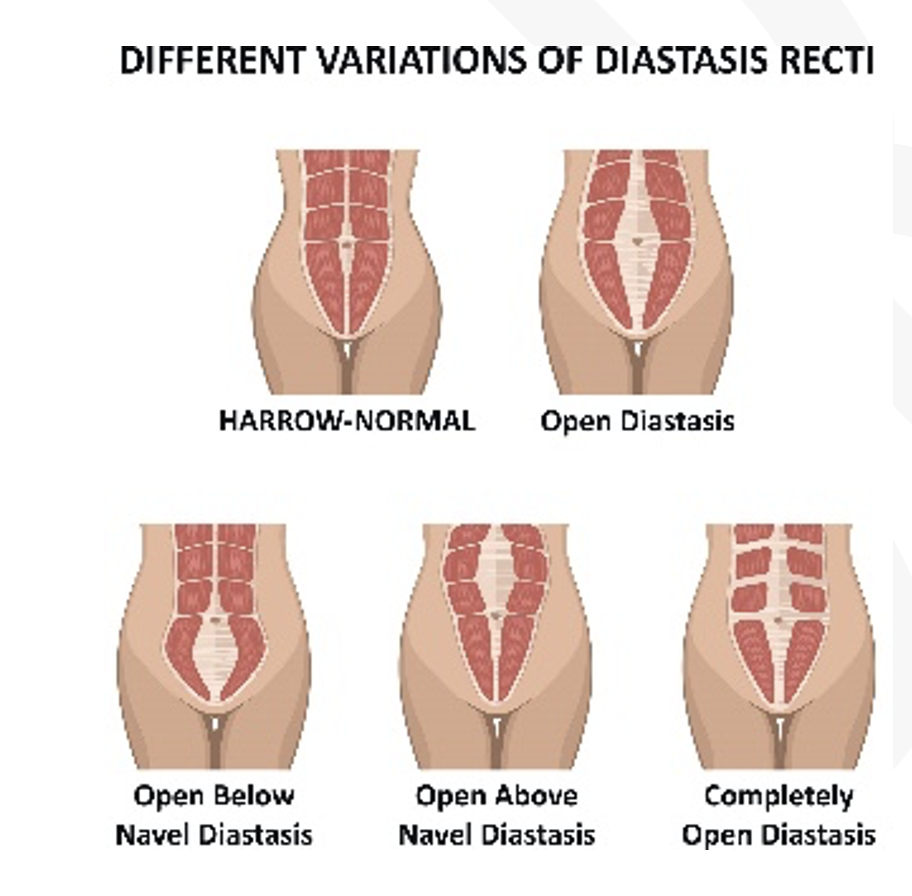 Abdominal diastasis recti: Cause, Symptoms, Treatment & Exercise